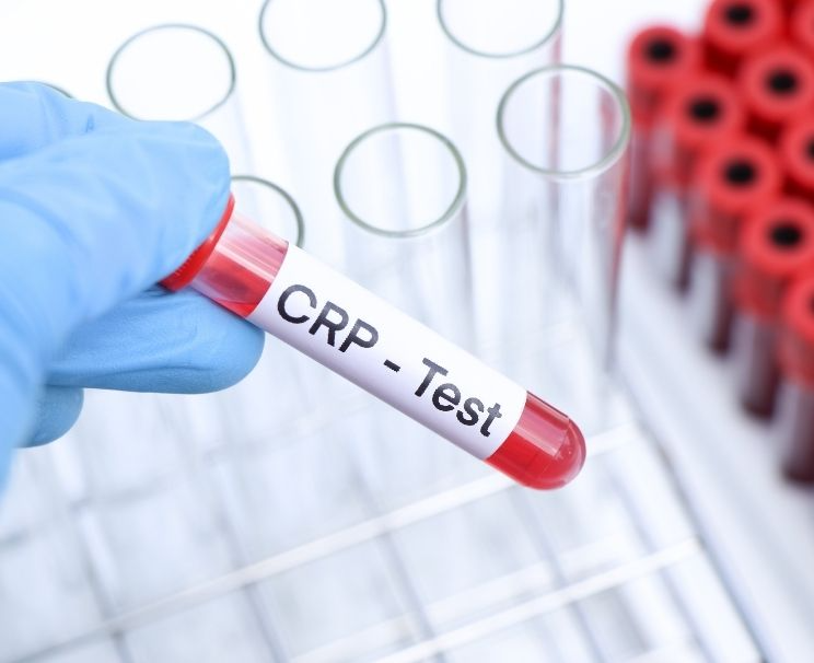 Kanser Hastalarında CRP Yüksekliği Kaç Olur?
